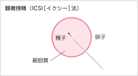 顕微授精（ICSI［イクシー］）