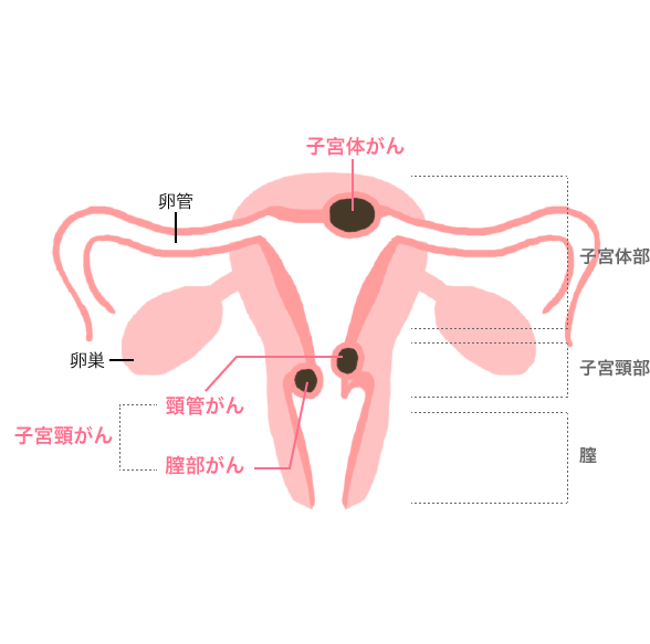 子宮の奥にできる子宮体がんと、子宮の入り口にできる子宮頚がん