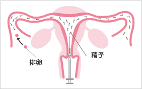 一般不妊治療