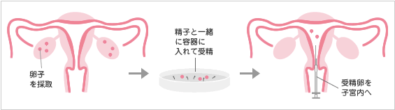 高度生殖医療